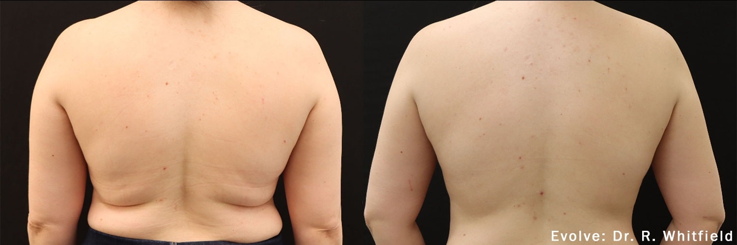 Non-Surgical Body in Collierville, TN