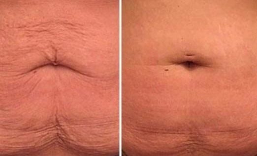 Body Aesthetics Treatment in Collierville