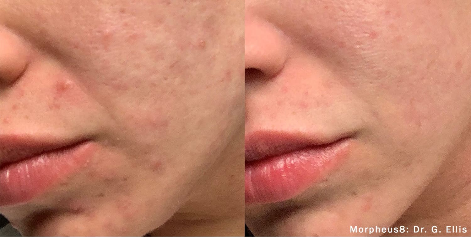 Morpheus8 Treatments in Collierville, TN