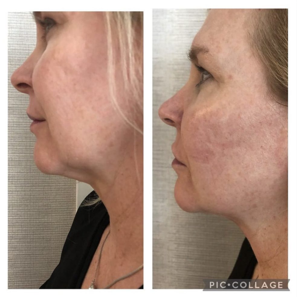 Evoke Treatment in Collierville, TN