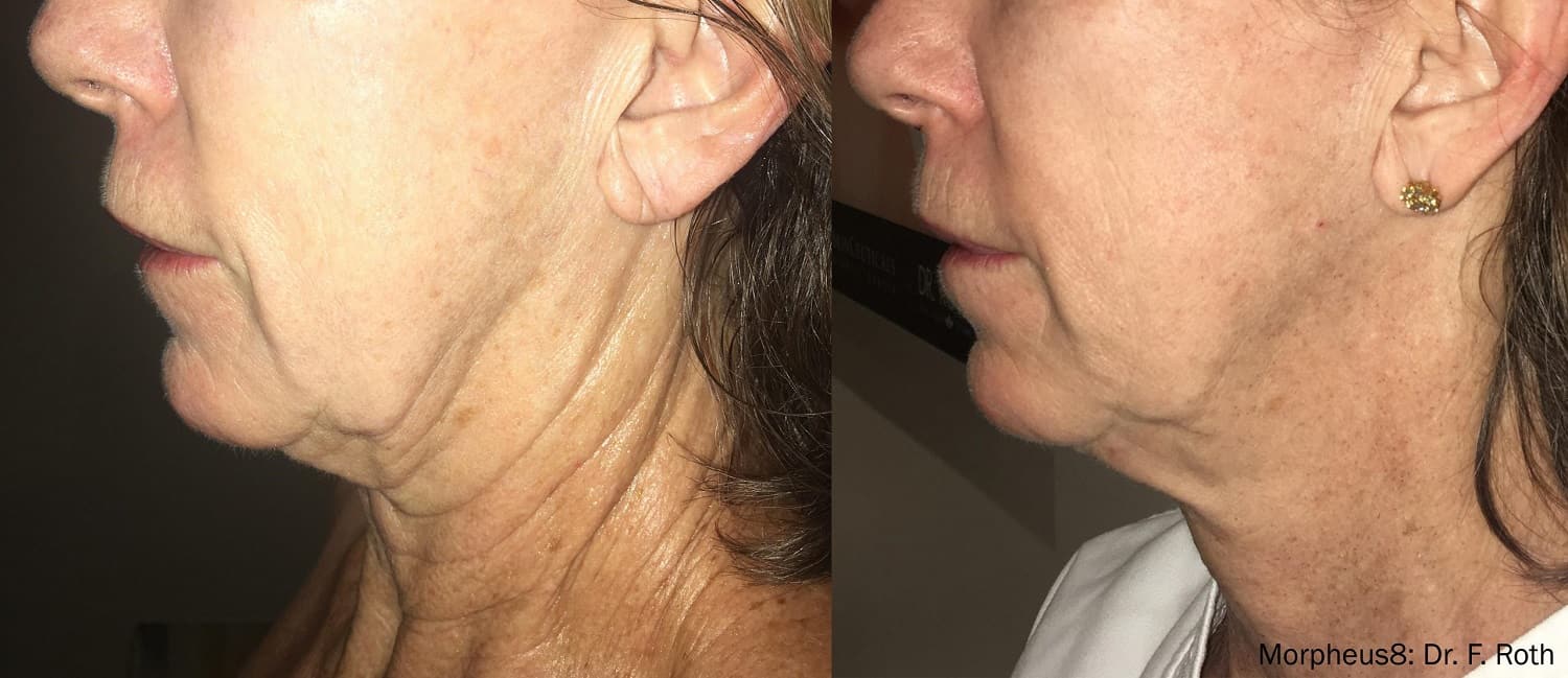 Morpheus8 Treatment in Collierville, TN